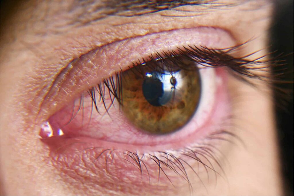 sindrome-del-ojo-seco-1.jpg