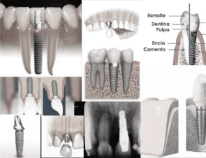 Implantes dentales: ciencia, salud y calidad de vida en la odontología moderna