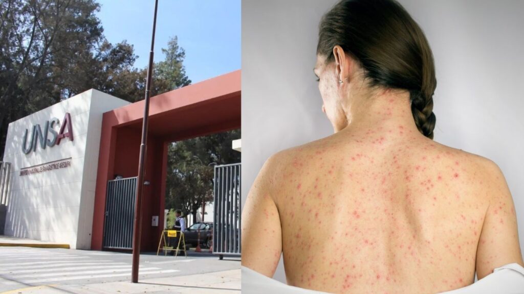 Sarampión en Arequipa: ¿Reacción tardía de las autoridades ante el primer caso en la UNSA?